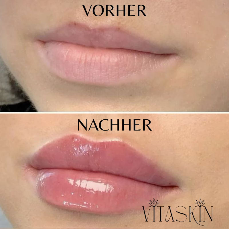 Anti-Falten Starter SET - VITASKIN Micro Infusion Kit für Zuhause