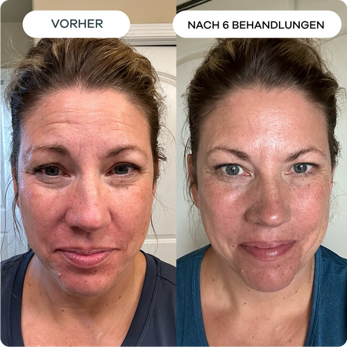 Anti-Falten Starter SET - VITASKIN Micro Infusion Kit für Zuhause