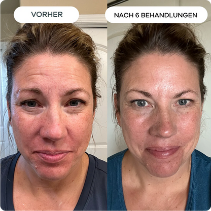 Anti-Falten Starter SET - VITASKIN Micro Infusion Kit für Zuhause