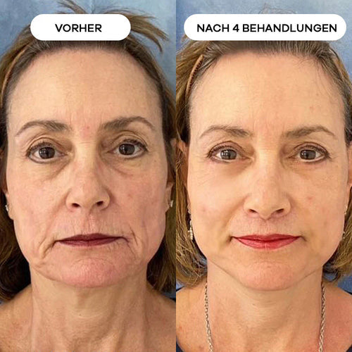 Anti-Falten Starter SET - VITASKIN Micro Infusion Kit für Zuhause