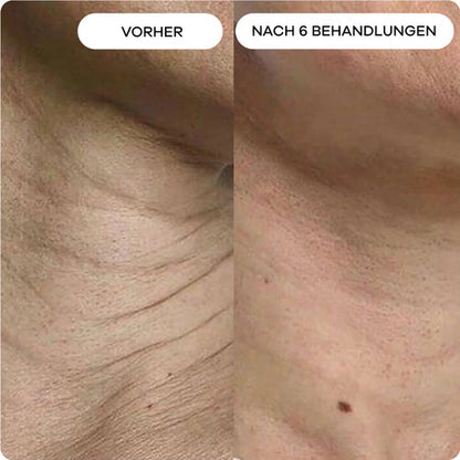 Anti-Falten Starter SET - VITASKIN Micro Infusion Kit für Zuhause