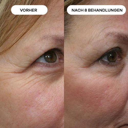 Anti-Falten Starter SET - VITASKIN Micro Infusion Kit für Zuhause