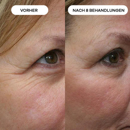 Anti-Falten Starter SET - VITASKIN Micro Infusion Kit für Zuhause