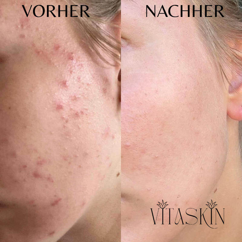 Anti-Falten Starter SET - VITASKIN Micro Infusion Kit für Zuhause