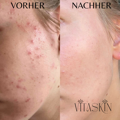 Anti-Falten Starter SET - VITASKIN Micro Infusion Kit für Zuhause