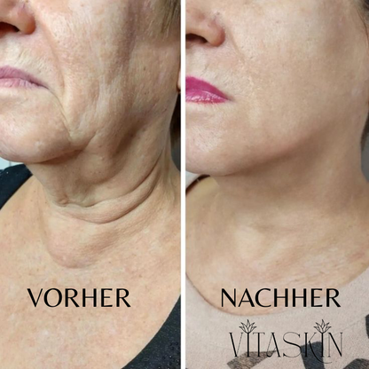 Anti-Falten Starter SET - VITASKIN Micro Infusion Kit für Zuhause