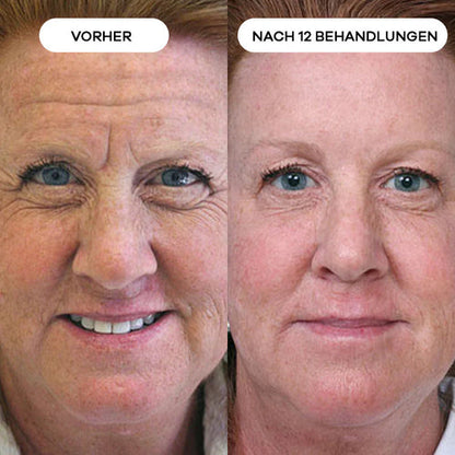 Anti-Falten Starter SET - VITASKIN Micro Infusion Kit für Zuhause